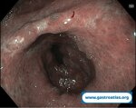 collagenous-gastritis