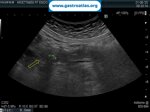 choledocholithiasis-ercp