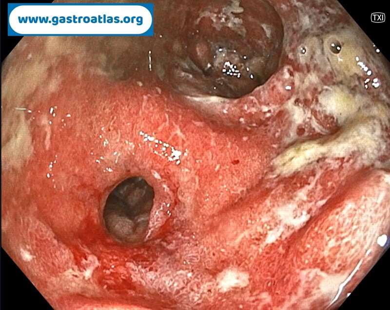 pre-anastomotic-fistula-in-colorectal-anastomosis-part-1-endoscopic-view