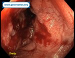 small-bowel-adenocarcinoma-sba-resulting-from-undiagnosed-celiac-disease