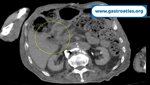 duodenal-bulb-perforation-peptic-ulcer