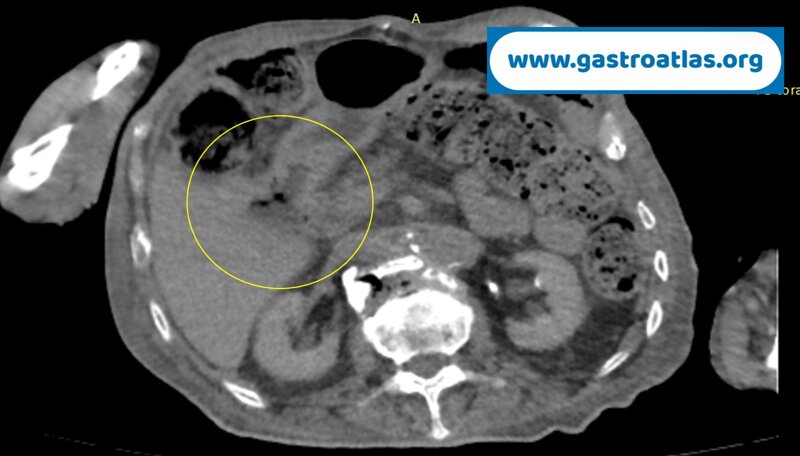 duodenal-bulb-perforation-peptic-ulcer