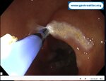 argon-plasma-coagulation-apc-treatment-of-gastric-antral-vascular-ectasia-gave