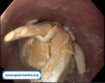esophagus-food-bolus-obstruction
