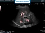 choledocholithiasis-ercp