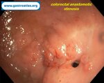 colorectal-anastomotic-stenosis