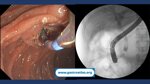 choledocholithiasis-ercp