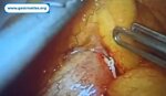 fishbone-induced-intestinal-perforation