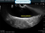 cystic-duct-stone-mrcp-and-eus