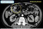 jejunal-hemangioma