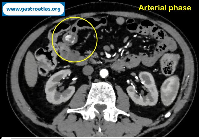 jejunal-hemangioma