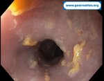 esophageal-stricture-in-endometrial-cancer