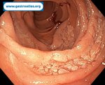 duodenal-adenoma