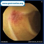jejunal-angiodysplasia-vce