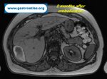 percutaneous-liver-biopsy-hematoma