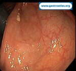 flat-lesion-of-right-colon-the-importance-of-nib-and-retroversion
