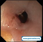 esophageal-stenosis-secondary-to-amyloidosis-part-1