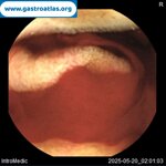 videocapsule-endoscopy-vce-in-glanzmanns-thrombasthenia