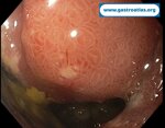 duodenal-bulb-perforation-peptic-ulcer