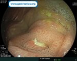 appendicitis
