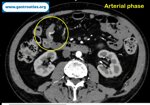 jejunal-hemangioma