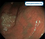 flat-lesion-of-right-colon-the-importance-of-nib-and-retroversion