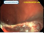 post-polypectomy-bleeding-coagrasper-use