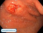 rectal-lymphoma