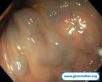 blue-rubber-bleb-nevus-syndrome-brbns