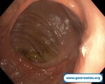 biliopancreatic-diversion-bpd-endoscopic-images