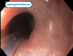 esophageal-stricture-secondary-to-amyloidosis-part-3-sems-removal