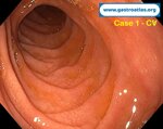 celiac-disease-two-unexpected-cases