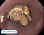 esophagus-food-bolus-obstruction