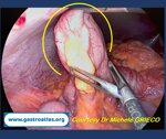 meckels-diverticulum