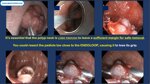 endoloop-polypectomy-tips-and-tricks