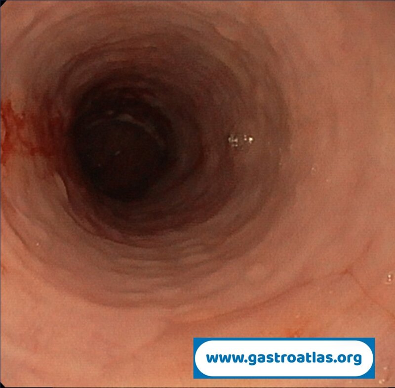 eosinophilic-esophagitis-mucosal-friability-and-esophageal-rings