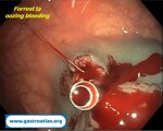 hemostatic-clip-a-fundamental-tool-in-endoscopy