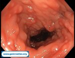 antibiotic-associated-colitis-caa-and-clostridium-difficile-infection-cdi