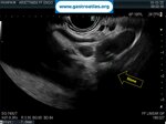 cystic-duct-stone-mrcp-and-eus