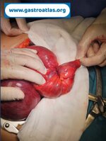 intestinal-occlusion-due-to-pelvic-endometriosis