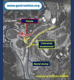 pre-anastomotic-fistula-in-colorectal-anastomosis-part-2-mri-view
