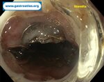 esophageal-stricture-secondary-to-amyloidosis-part-2