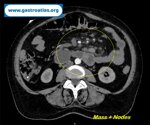 small-bowel-adenocarcinoma-sba-resulting-from-undiagnosed-celiac-disease