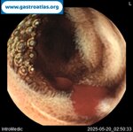 videocapsule-endoscopy-vce-in-glanzmanns-thrombasthenia