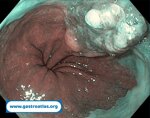 esophageal-adenocarcinoma-in-gastric-banding