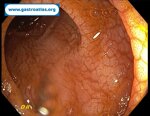 small-bowel-adenocarcinoma-sba-resulting-from-undiagnosed-celiac-disease