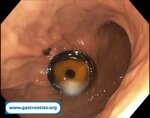 gastric-ulcer-in-percutaneous-endoscopic-gastrostomy-peg