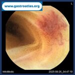 jejunal-angiodysplasia-vce