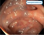 blue-rubber-bleb-nevus-syndrome-brbns