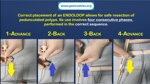 endoloop-polypectomy-tips-and-tricks